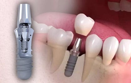 Un impianto dentale accanto a un dente